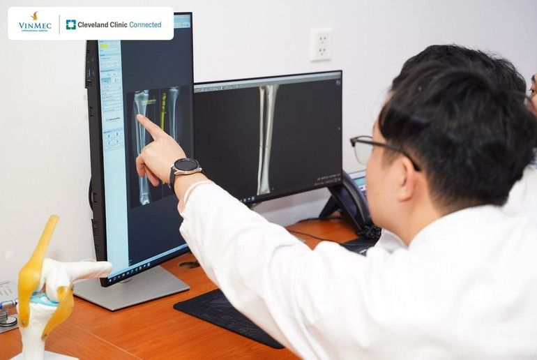 Kết quả hội chẩn ghi nhận: Xuân Son bị gãy kín phức tạp 1/3 giữa thân hai xương cẳng chân, có mảnh rời lớn.