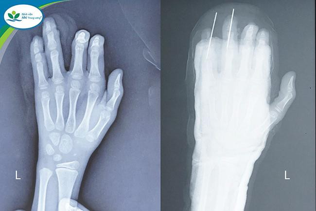 Tổn thương của bệnh nhi.