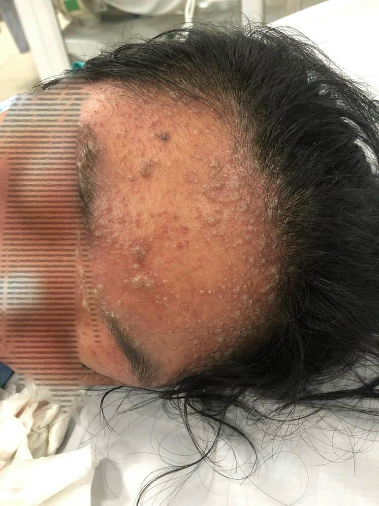 Bệnh nhân bị bội nhiễm nặng nề do mắc thủy đậu.