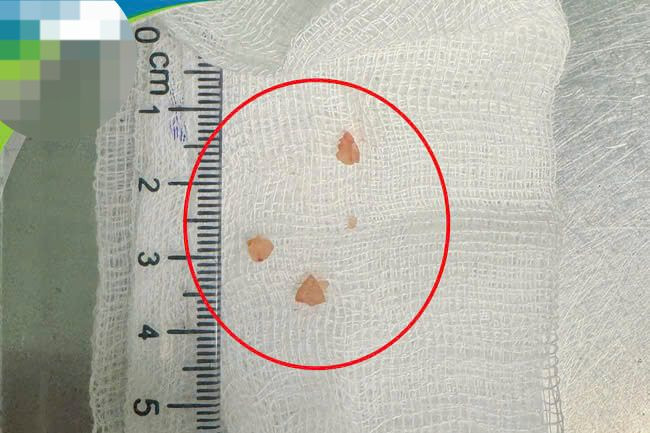 Dị vật là hạt lạc gắp từ trong đường thở của bệnh nhi.