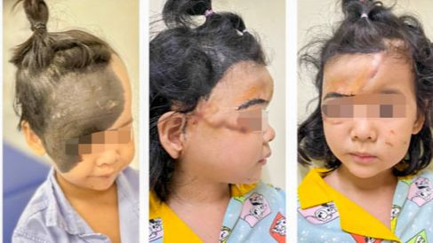 Hình ảnh bé trước và sau phẫu thuật.