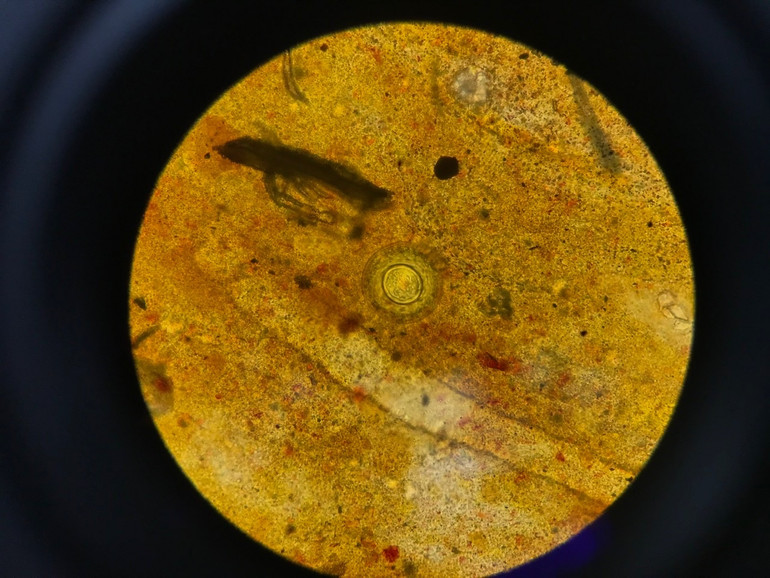 Hình ảnh trứng sán dây nhỏ Hymenolepiasis của bệnh nhân đến khám.