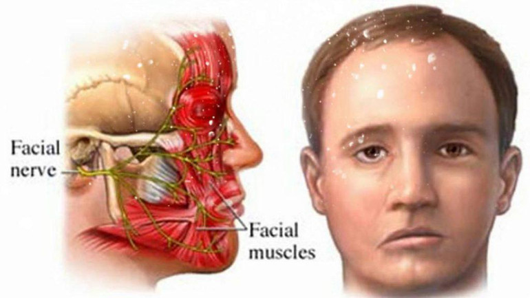 Châm cứu chữa liệt dây thần kinh số 7. Châm cứu chữa liệt dây thần kinh số 7.