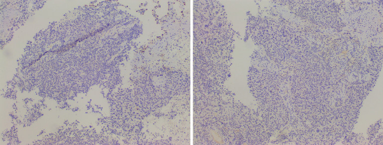 Kết quả xét nghiệm hóa mô miễn dịch của bệnh nhân.