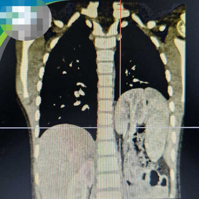 Hình ảnh chụp thoát vị hoành trái bẩm sinh với tạng thoát vị là lách, ruột non, đại tràng và kèm theo thận lạc chỗ trên lồng ngực của trẻ.