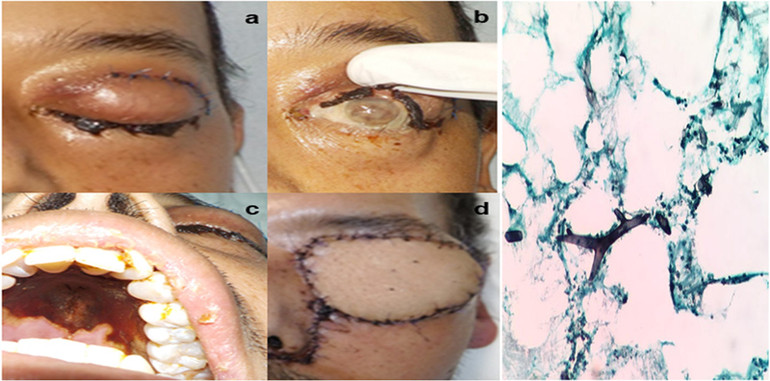 Một số hình ảnh tổn thương của bệnh nấm đen và hình ảnh sợi nấm đen. (Ảnh minh họa)