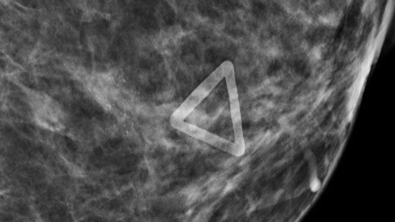 Hình ảnh ung thư vú (vùng hình tam giác) được phóng to trên phim chụp X-quang 3D.