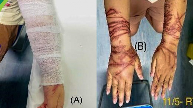 Tổn thương của bệnh nhi đã giảm dần sau thời gian điều trị.