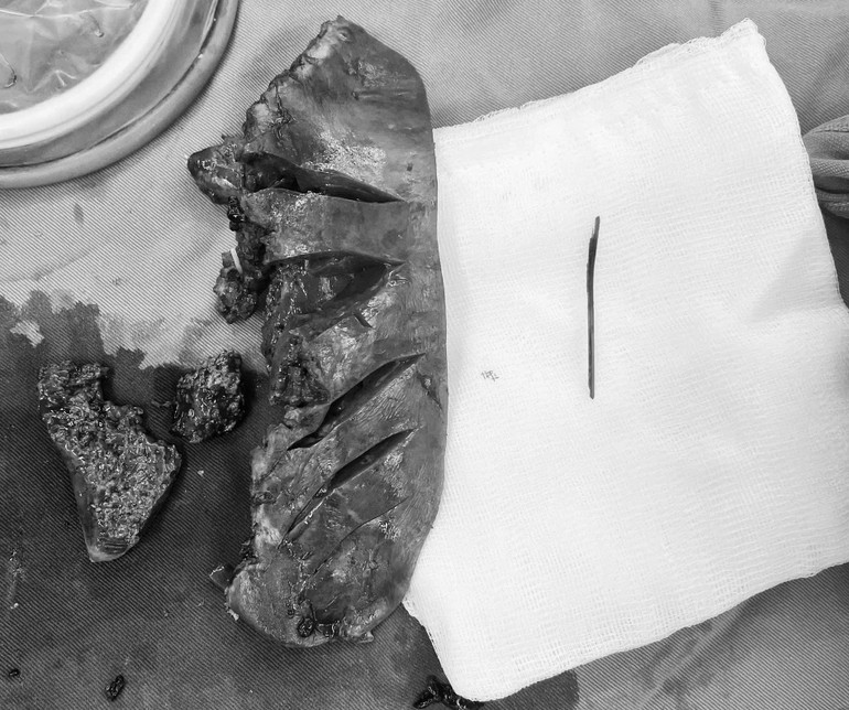 Hình ảnh tăm tre gây ra áp xe gan. Hình ảnh tăm tre gây ra áp xe gan.