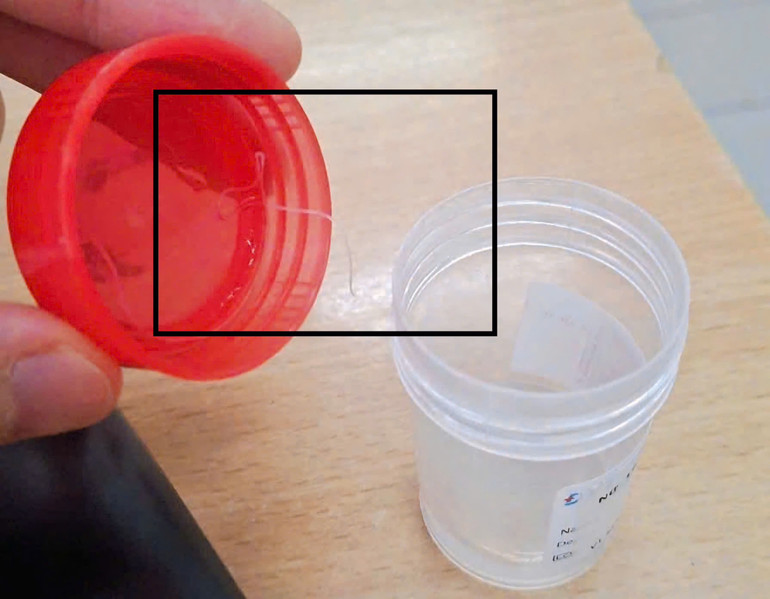 Hình ảnh ký sinh trùng được lấy ra từ mắt bệnh nhân, đang được phân tích tại phòng xét nghiệm ký sinh trùng học.