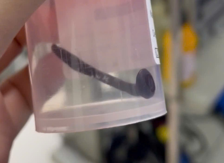 Dị vật là đỉa chui vào đường thở của bệnh nhi.