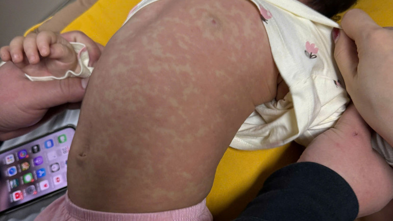 Ban đỏ toàn thân.