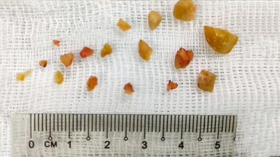 Dị vật hạt lạc được phá thành nhiều mảnh nhỏ để lấy ra ngoài. Dị vật hạt lạc được phá thành nhiều mảnh nhỏ để lấy ra ngoài.