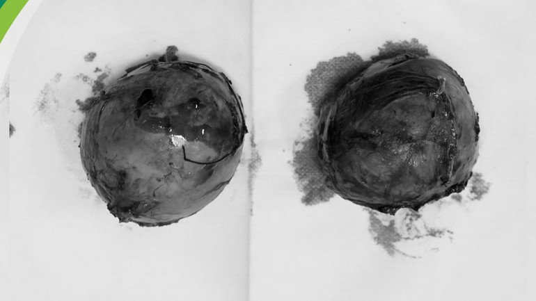 Khối u tuyến thượng thận được loại bỏ.