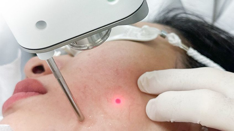 Điều trị giãn mạch máu, trẻ hoá da bằng công nghệ laser mới Nd:YAG xung dài.