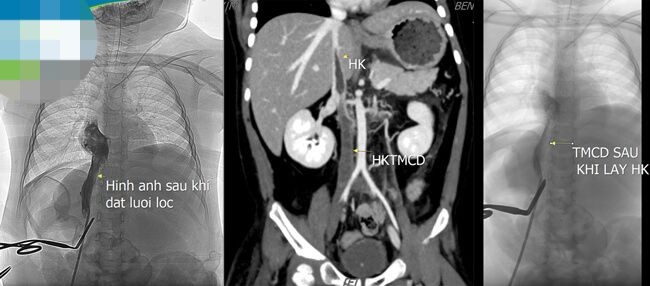 Hình ảnh huyết khối của trẻ trước và sau khi được phẫu thuật.