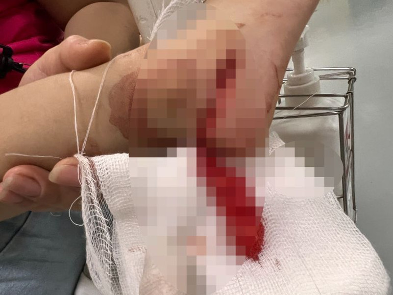 Trẻ bị thương tích nặng do sự bất cẩn của người lớn.