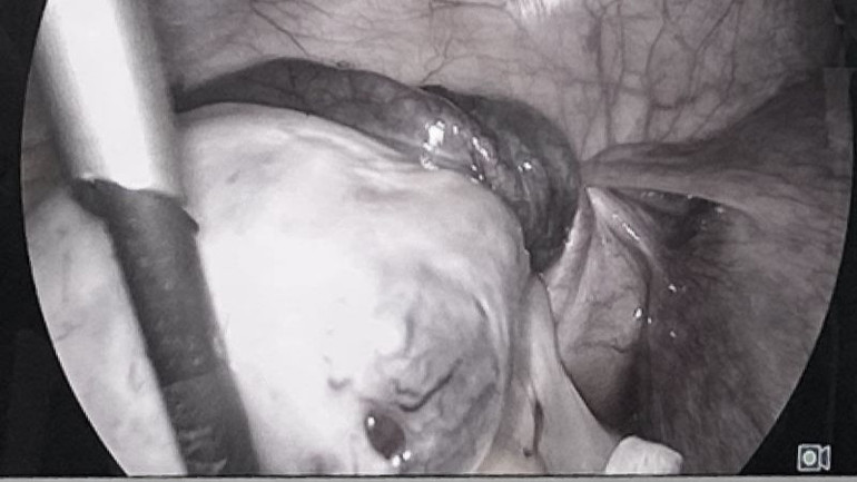 Hình ảnh u xoắn buồng trứng.