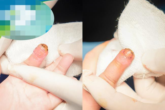 Đầu ngón tay trẻ hồng ấm, tiến triển tốt.