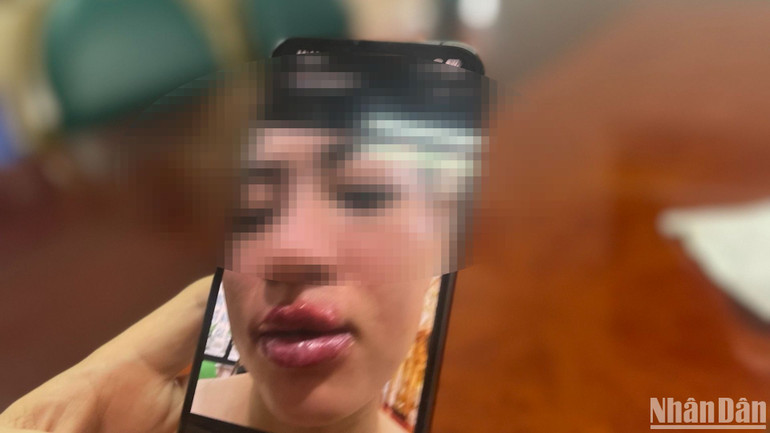 Trường hợp bệnh nhân gặp biến chứng viêm môi sau khi xăm.