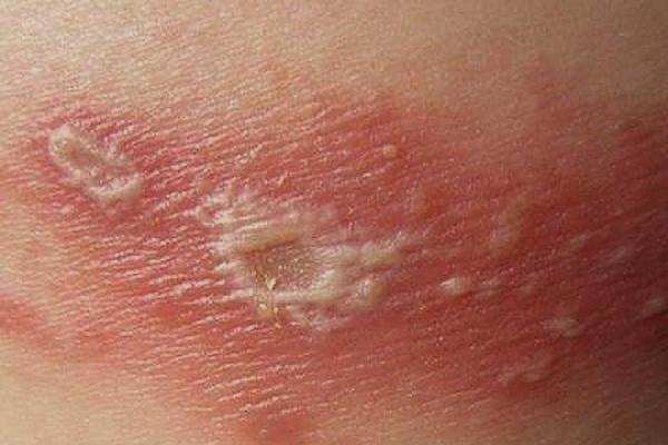 Tổn thương da do tiếp xúc kiến ba khoang.