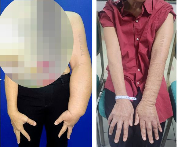 Bệnh nhân trước mổ và sau mổ phù bạch mạch cánh tay bằng chuyển hạch siêu vi phẫu.