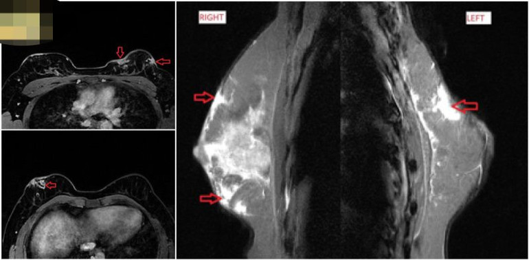 Biến chứng thẩm mỹ sau tiêm mỡ tự thân. Biến chứng thẩm mỹ sau tiêm mỡ tự thân.