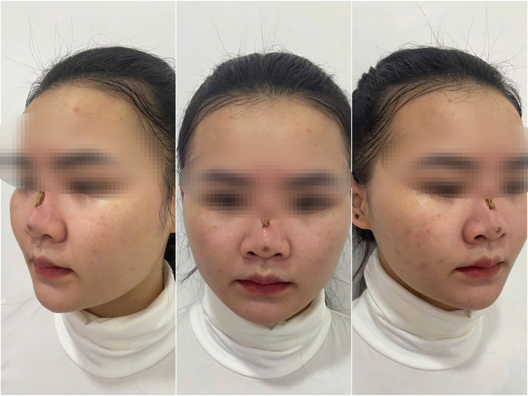 Biến chứng sau căng chỉ nâng mũi. Biến chứng sau căng chỉ nâng mũi.