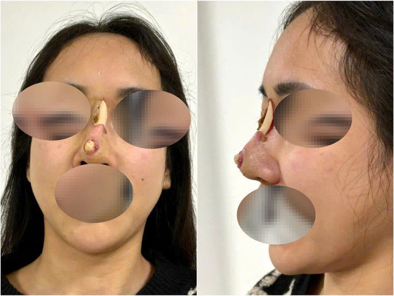 Bệnh nhân nhiễm trùng nặng, hoại tử ở vùng da sống mũi, đầu mũi, lộ chất liệu nâng mũi. Bệnh nhân nhiễm trùng nặng, hoại tử ở vùng da sống mũi, đầu mũi, lộ chất liệu nâng mũi.