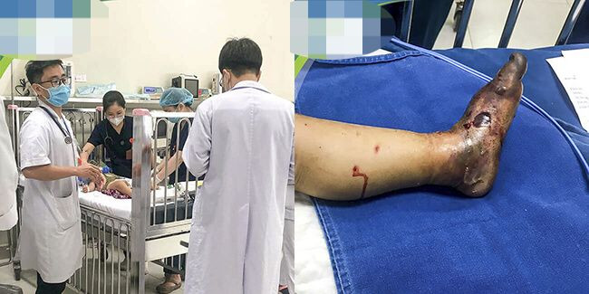 Ngón cái bàn chân trái của bệnh nhi bị rắn cắn đã hoại tử khô.