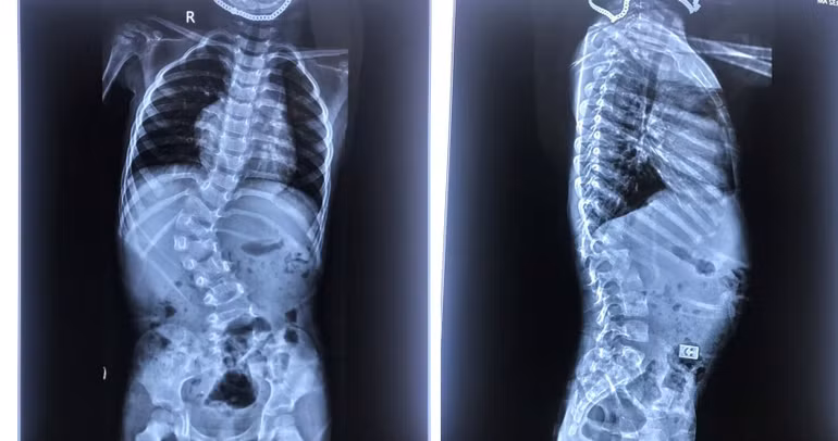 Hình ảnh X-quang trẻ cong vẹo cột sống.