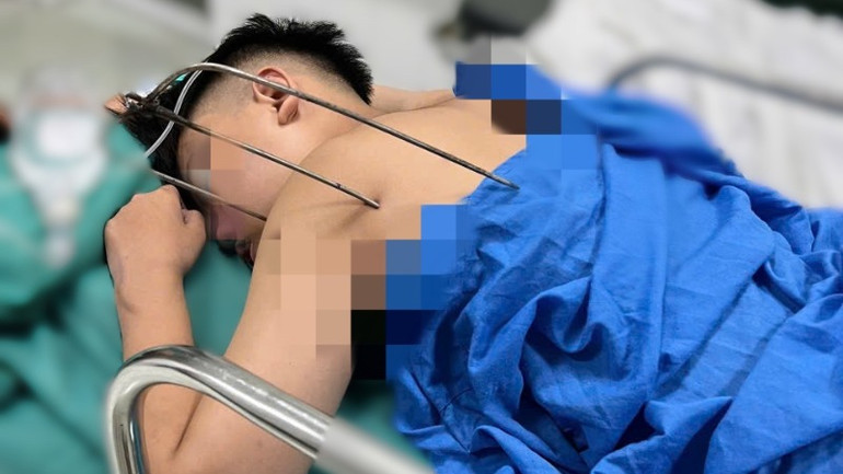 Dị vật đâm thấu tim người bệnh. Dị vật đâm thấu tim người bệnh.