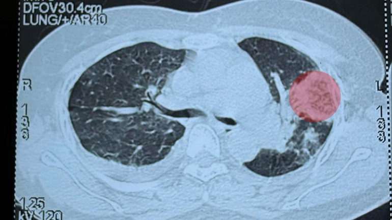 Ổ áp xe trong phổi bệnh nhân trên phim chụp.