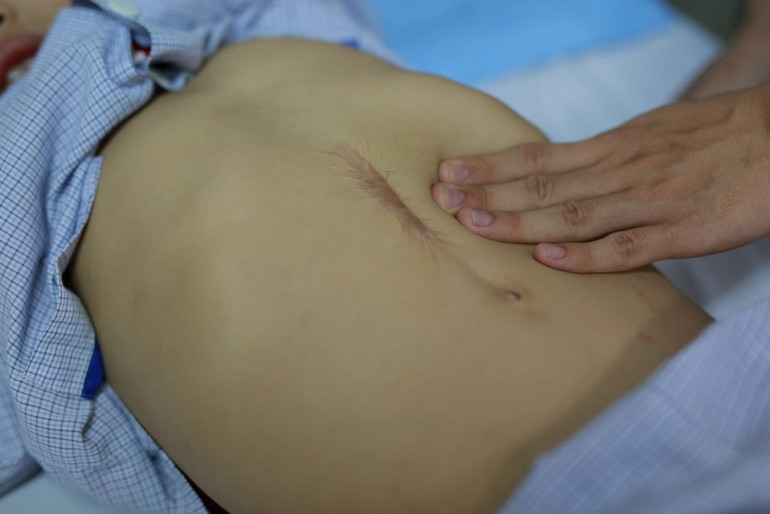 Bệnh nhân mắc bệnh tan máu bẩm sinh.