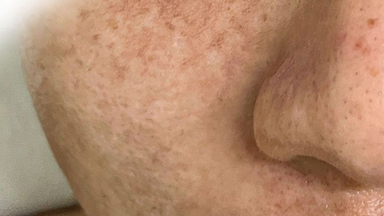 Một trường hợp bị tăng sắc tố sau viêm, nám nặng hơn do peel da tại nhà.