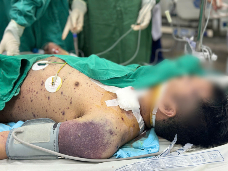 Bệnh nhân có dấu hiệu quan trọng của nhiễm trùng huyết nặng.