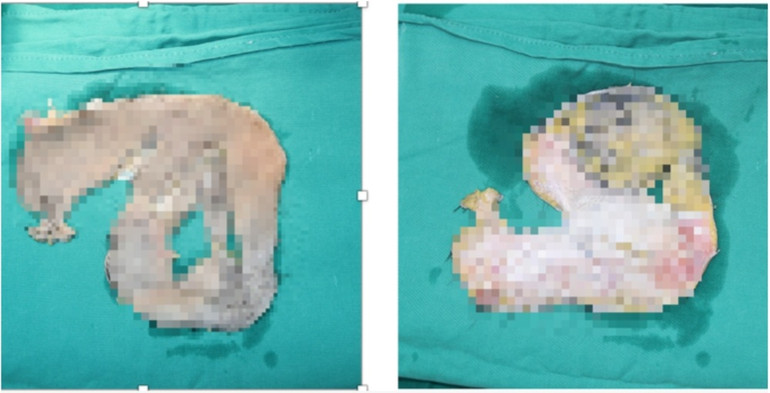 Da đầu bị lột đứt rời.