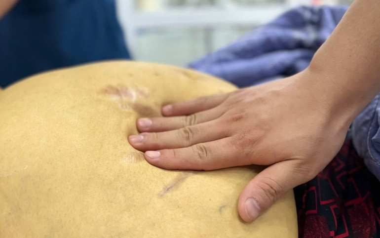 Bệnh nhân có da và mắt vàng sẫm, phù toàn thân.