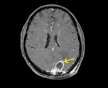 Bệnh nhân whitmore bị ép xe não thuỳ chẩm đỉnh trái. Bệnh nhân whitmore bị ép xe não thuỳ chẩm đỉnh trái.