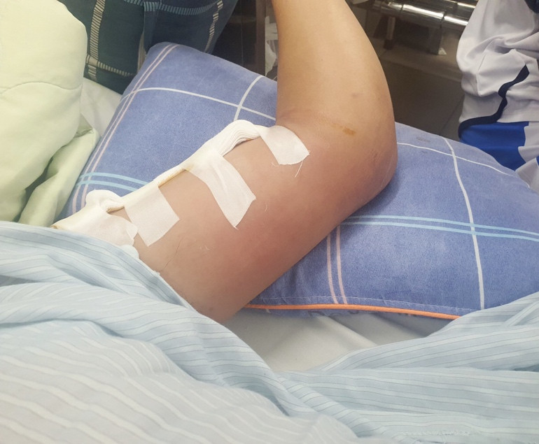 Nguy cơ nhiễm dịch bệnh sau bão lũ: Cảnh giác với bệnh whitmore ảnh 1 Nguy cơ nhiễm dịch bệnh sau bão lũ: Cảnh giác với bệnh whitmore ảnh 1