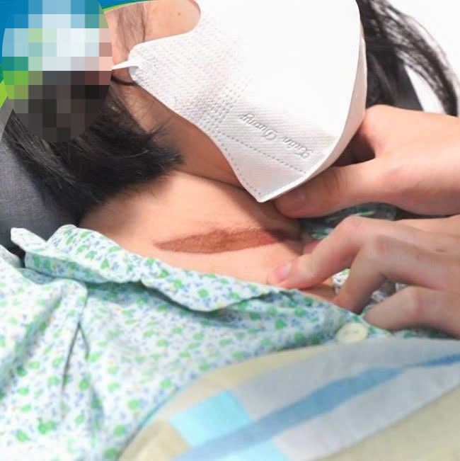 Vết thương ở cổ của bệnh nhi. Vết thương ở cổ của bệnh nhi.