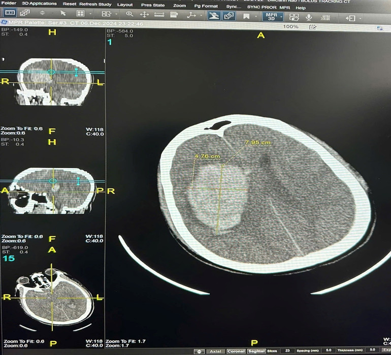 Hình ảnh phim CLVT của bệnh nhân Đ.V. Đ: khối máu tụ bán cầu phải với thể tích khoảng 90cm3.