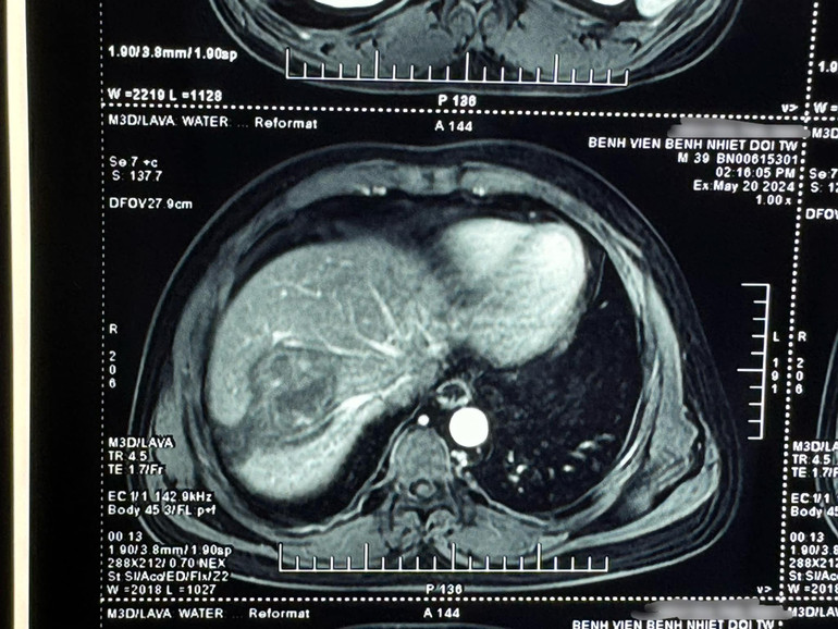 Hình ảnh ổ sán lá gan lớn của bệnh nhân.