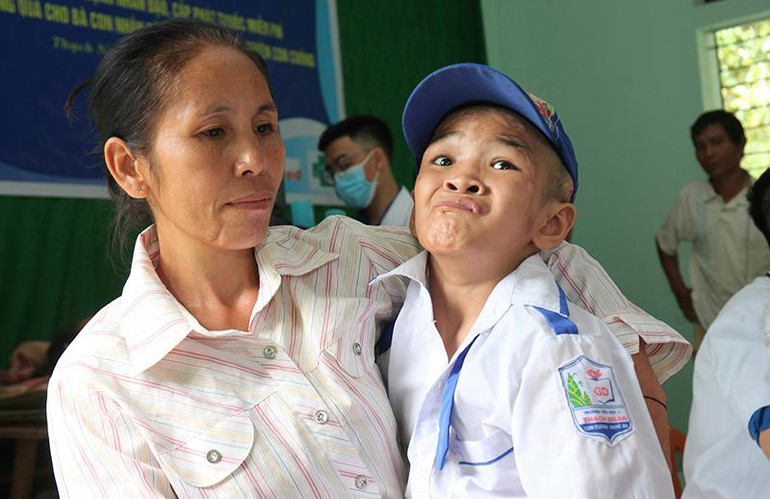 Chị Vi Thị Thủy (46 tuổi) cõng con trai là cháu Lô Kim Chi (13 tuổi) bị tật bẩm sinh đến Nhà văn hóa bản Thạch Sơn đã được bác sĩ khám chu đáo. Chị Thủy hết sức cảm kích khi con mình được các y bác sĩ thăm khám, chuẩn đoán bệnh, phát thuốc miễn phí.