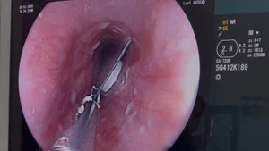 Viên thuốc còn nguyên bao kẽm kẹt trong thực quản người bệnh.