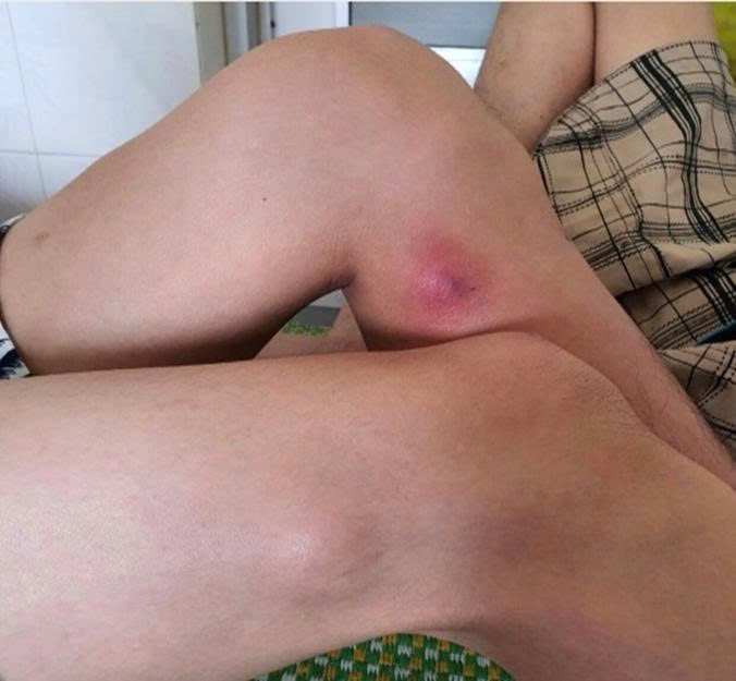 Vết thương của người mắc giun rồng. z6740073331467-6a2e4b6e83de3f05faf61f95184e5b17.jpg