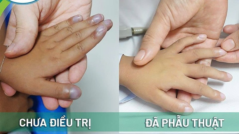 Bàn tay bệnh nhi đã trở về bình thường sau phẫu thuật bệnh tim bẩm sinh. 557022107-813992984521455-7001580066092888977-n-1311.jpg