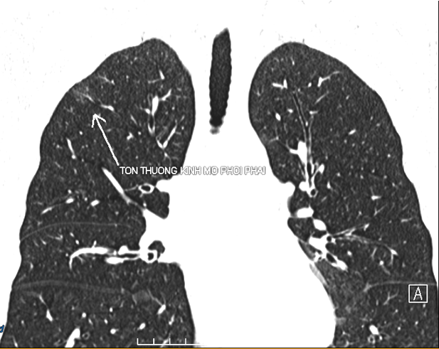Hình ảnh tổn thương thần kinh mô phổi phải. picture-1.png