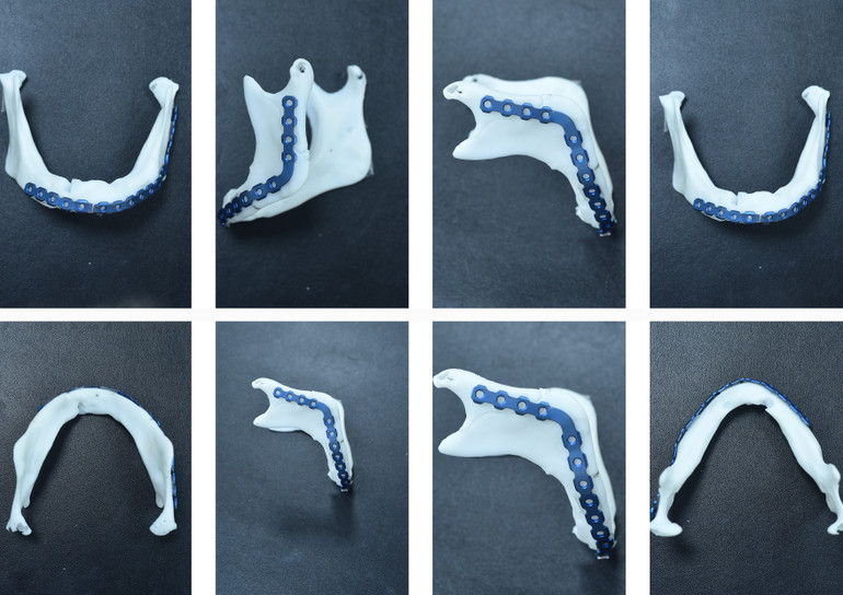 In 3D mẫu hàm lập thể. f651b66a-43fb-4ba1-95bc-1d3c9e6478ca.jpg