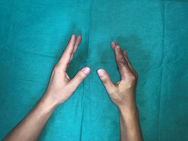 Operationen lyckades och fingret fästes igen efter 25 timmar. noitay.jpg